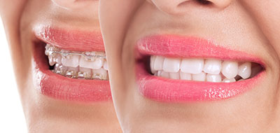 The image is a composite of two photos, one showing a person s face with an open mouth and the other featuring a close-up of a smiling mouth with teeth.