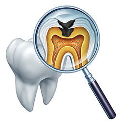 The image is a digital illustration of a magnified view of the interior of a tooth, showing the root with an enlarged pulp cavity and an associated oral infection.