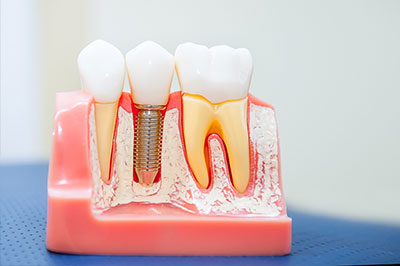 The image displays a model of a human tooth with visible dental implants, held in place by screws, and showcasing the implantation process.