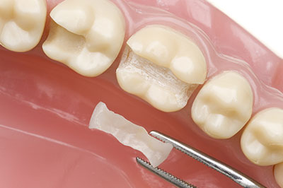 Dental implant with a visible abutment and surgical instruments, showcasing a dental restoration process.