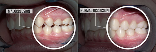 The image is a composite of two photos, showing a side-by-side comparison of a person s mouth before and after a dental procedure.
