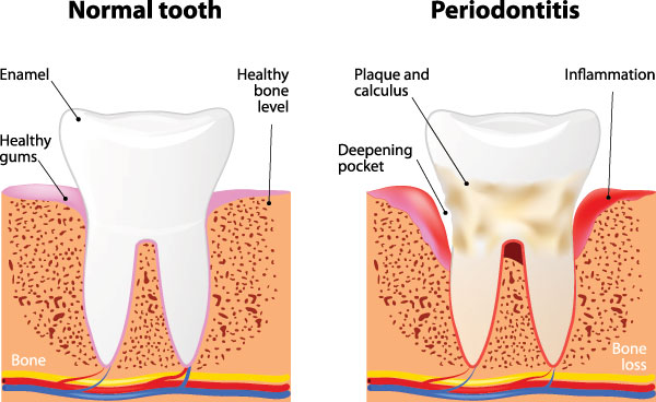 The image is a medical illustration showing the stages of tooth decay progressing from normal to periodontitis, with annotations pointing out the bone and gum levels affected by the condition.