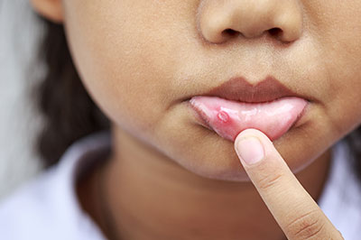 The image displays a close-up of a young child s face, with the focus on their lips and mouth area. The child appears to be touching or examining their lips, which are slightly swollen or inflamed, suggesting some form of irritation or discomfort.