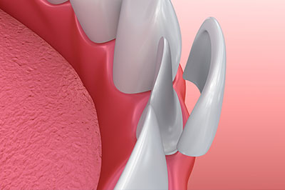 The image shows a close-up view of a dental implant fixture with a pink gum background, emphasizing the surgical aspect of dental implant placement.