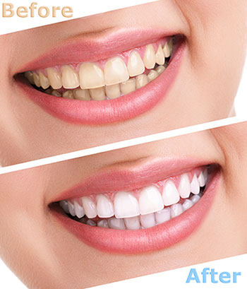The image shows a before-and-after comparison of a teeth whitening treatment, with the left side depicting yellowed teeth and the right side showing bright white teeth.