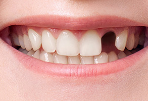 The image shows a close-up of a person s smile with a focus on their teeth, which are white and well-maintained.