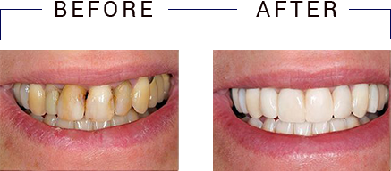 The image shows a side-by-side comparison of a person s teeth before and after dental treatment, with the after image showing a bright smile with a clean, straight appearance.