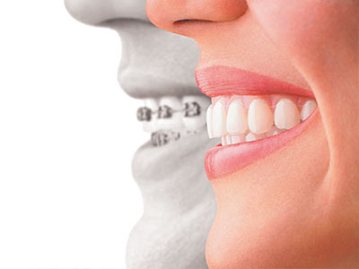 A split image of a smiling woman with one half showing her natural teeth and the other depicting a dental implant.