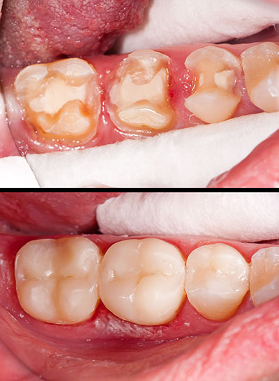 Dental patient s mouth with severe tooth decay, before and after treatment comparison.