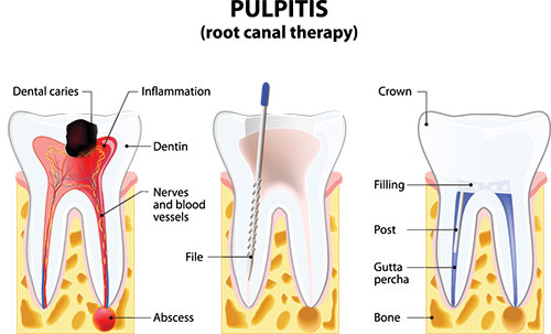 The image is a medical illustration showing the process of pulpitis in teeth, with annotations that describe the different stages and structures involved.