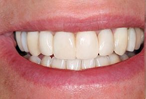 The image shows a close-up of a person s smile, with their teeth prominently visible.