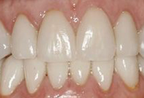 The image displays a close-up view of a person s mouth with teeth that appear to be in the process of being straightened or aligned, as indicated by the presence of braces.