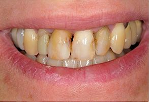 A close-up of a person s teeth with a yellowish tint, likely due to staining or discoloration.