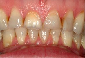 An image of a close-up view of a person s teeth with visible staining and discoloration, showcasing the need for dental care.